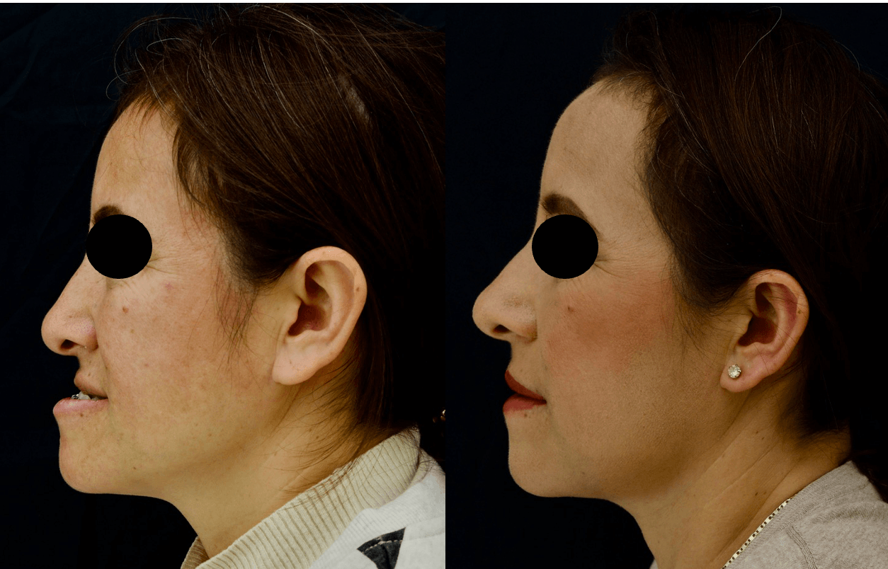 cirugia-ortognatica-en-quretaro-clinica-oralmaxq