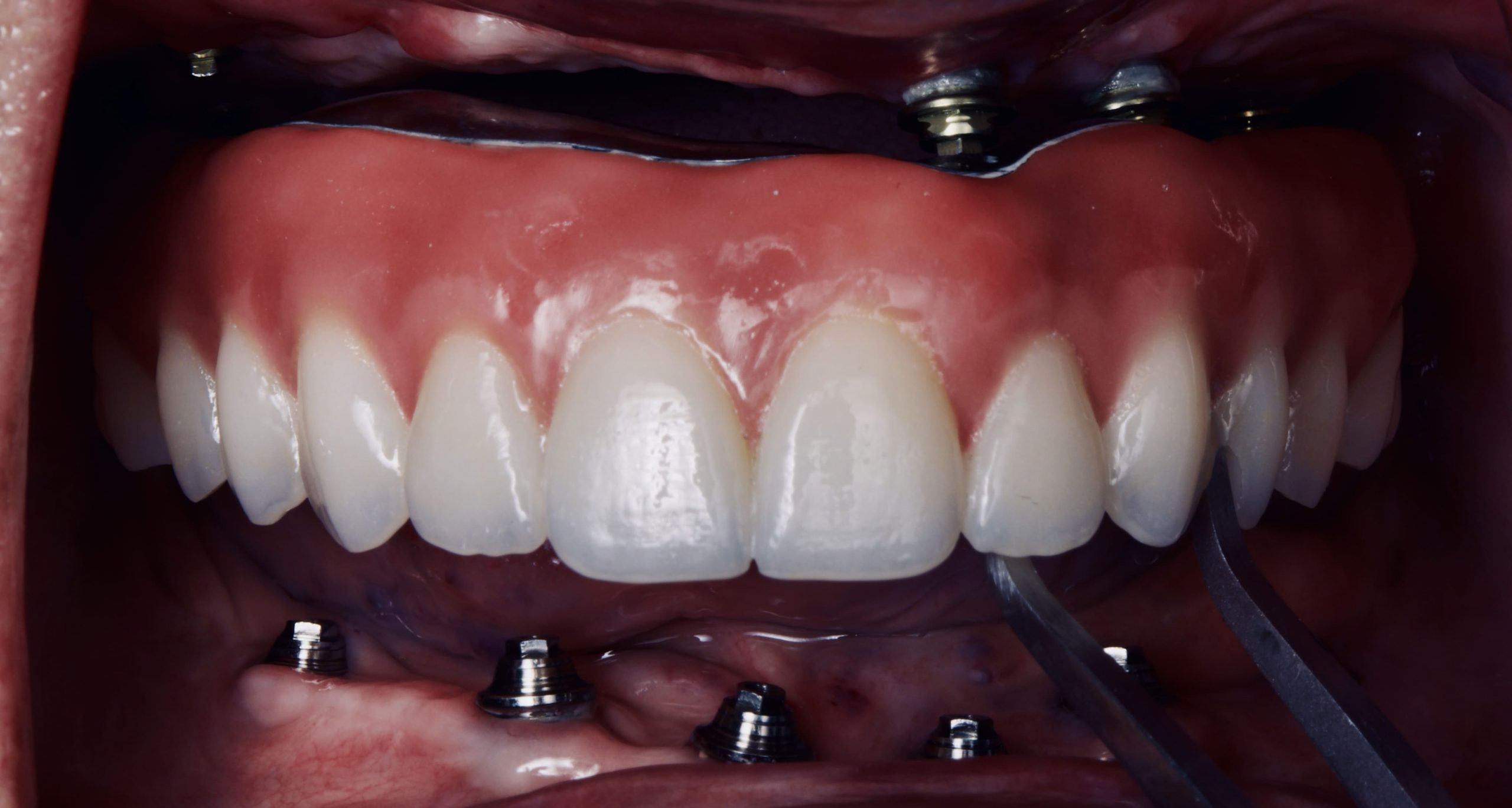 implantes-all-on-x-clinica-oralmaxq