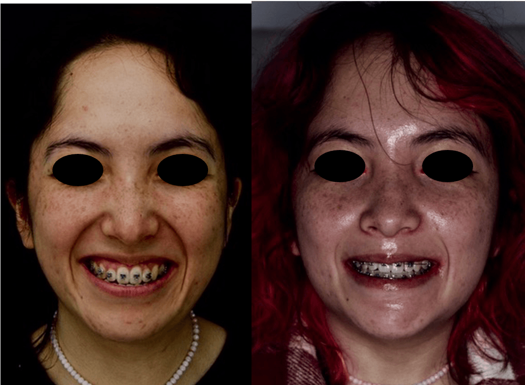 proceso-del-tratamiento-cirugia-ortognatica-oralmaxq
