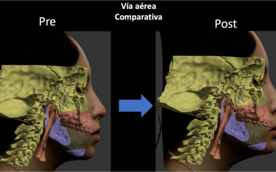 Cirugía ortognática o cirugía ortofacial: diferencias y cuándo puede indicarse cada una