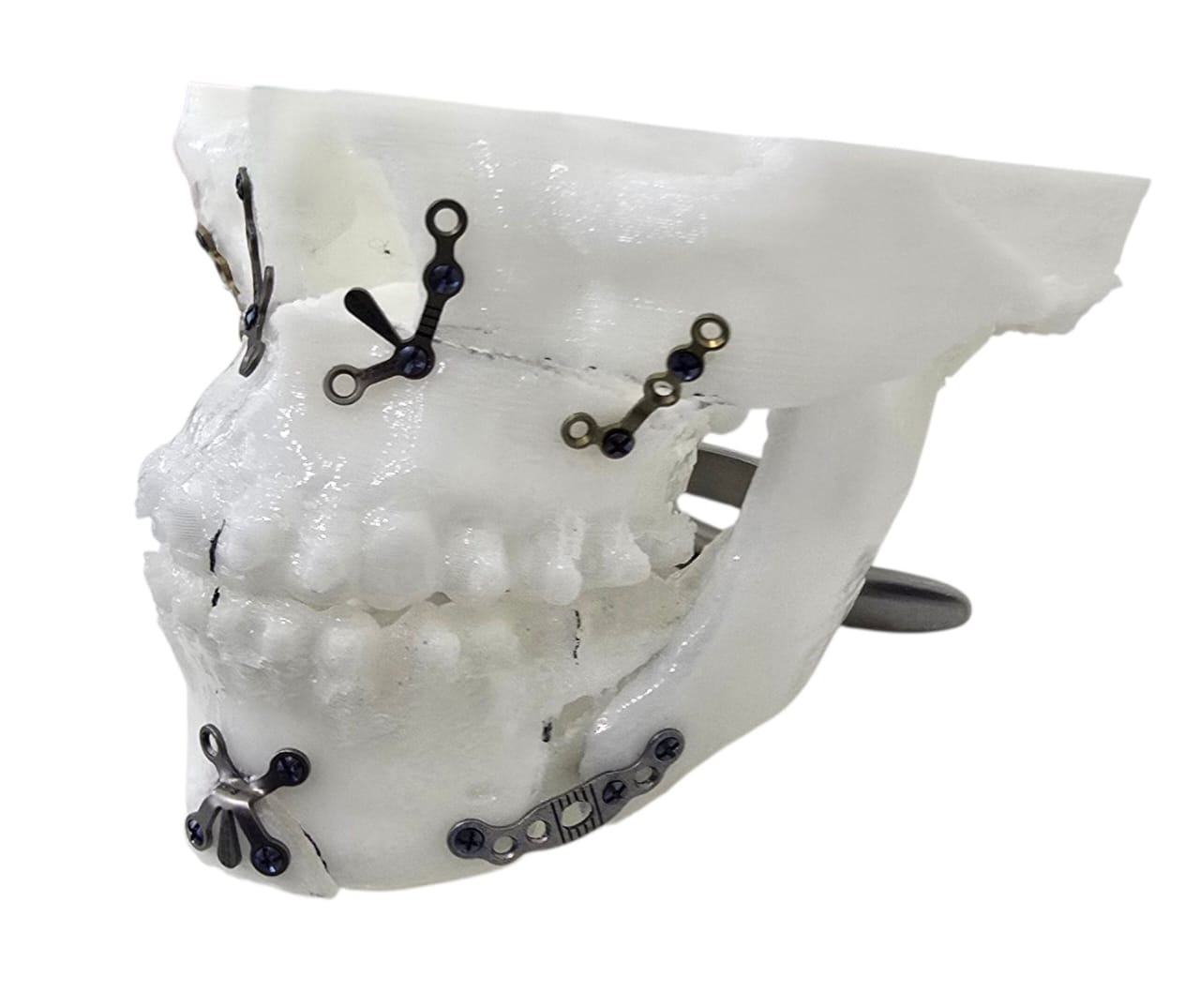 tipos-de-cirugias-ortognaticas-clinica-oralmaxq