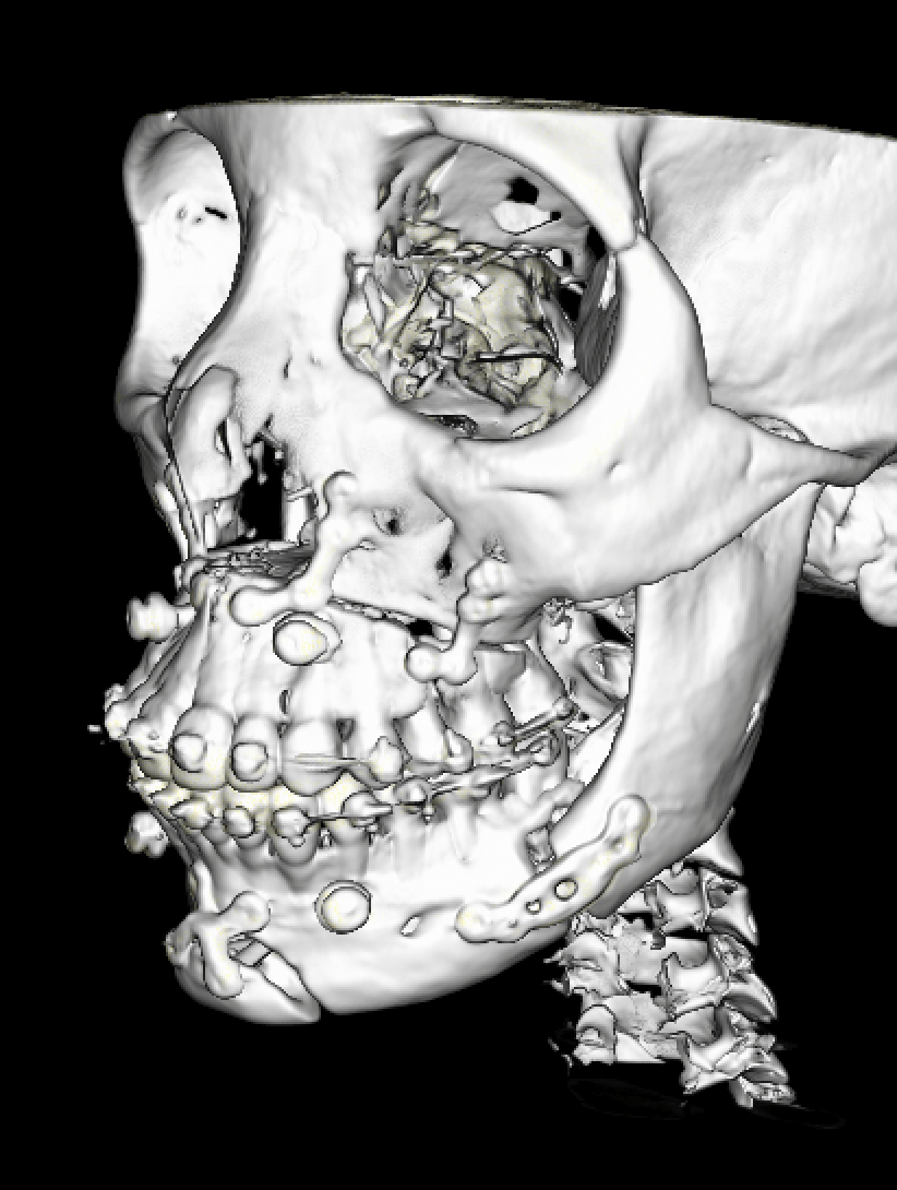 tipos-de-cirugias-ortognaticas-clinica-oralmaxq2