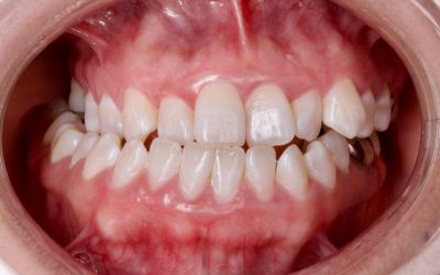 Tipos de mordida: maloclusiones y alteraciones faciales más comunes