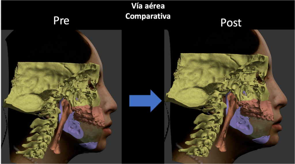 la-cirugia-ortognatica-puede-ayudar-en-casos-de-saos-clinica-oralmaxq