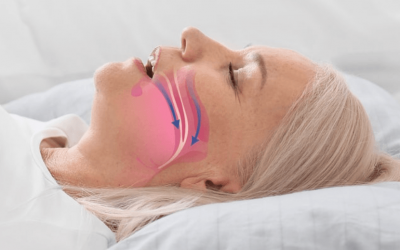 ¿Qué es el SAOS? Síndrome de Apnea Obstructiva del Sueño