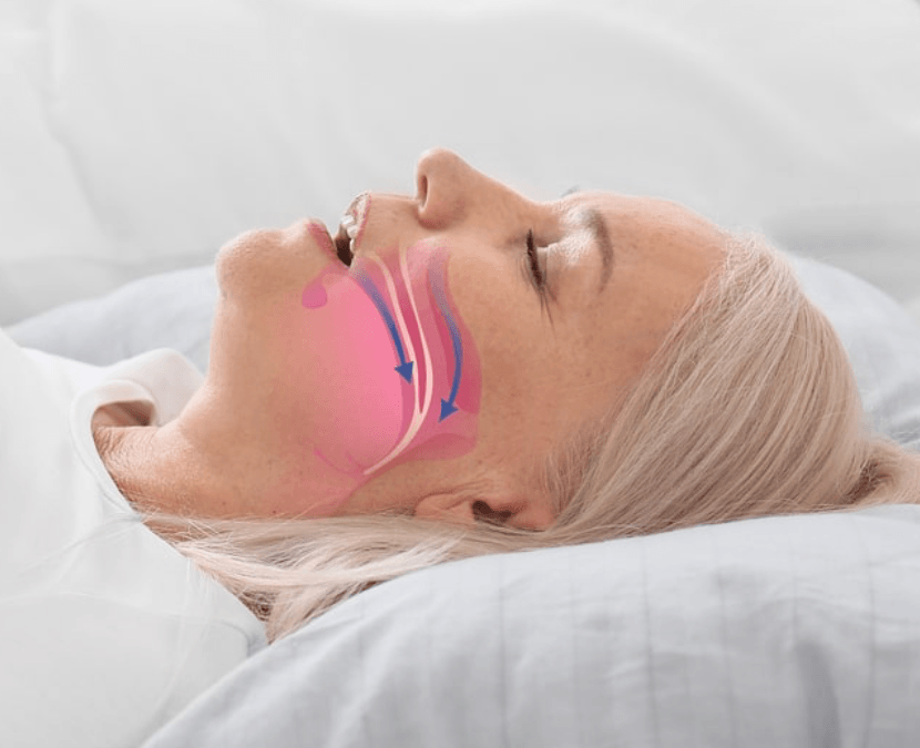 que-es-el-saos-sindrome-apnea-obstructiva-del-sueño-oralmaxq
