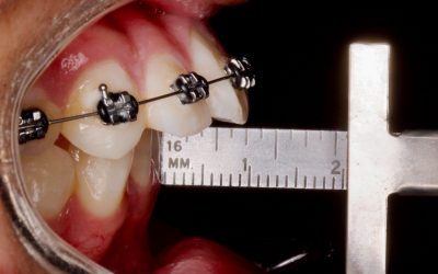 La relación entre la ortodoncia y la cirugía ortognática