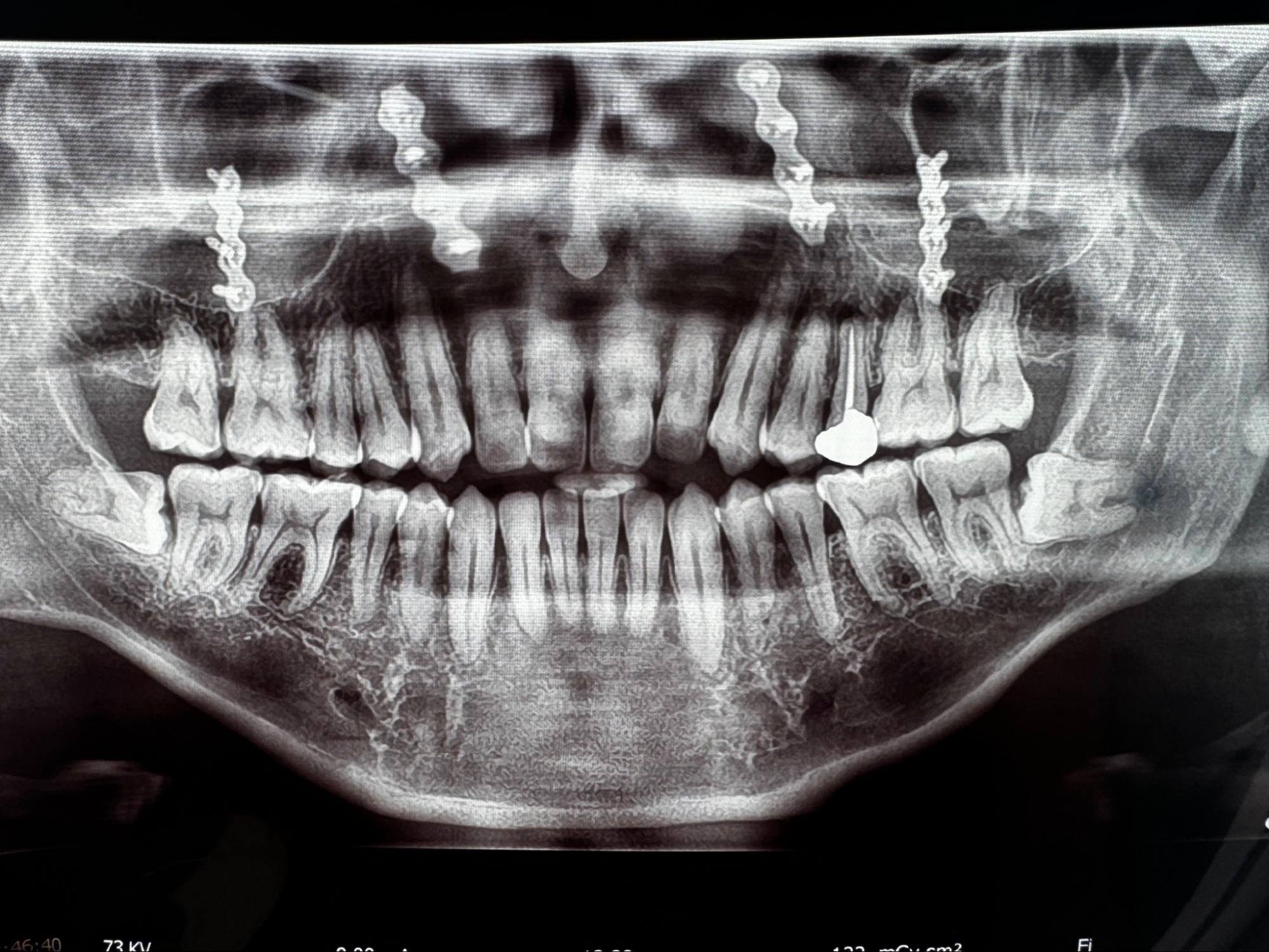 extraccion-muelas-de-juicio-en-queretaro-clinica-oralmaxq