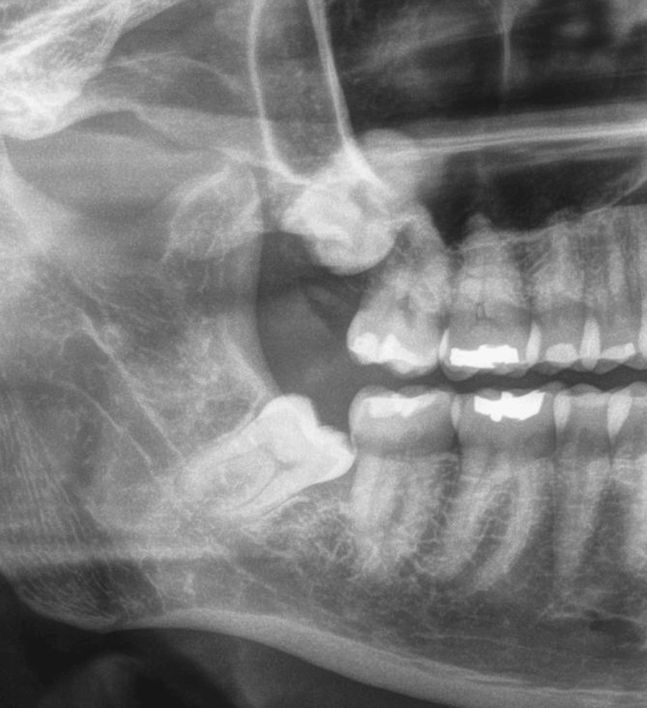 valoración-de-terceros-molares-clinica-oralmaxq