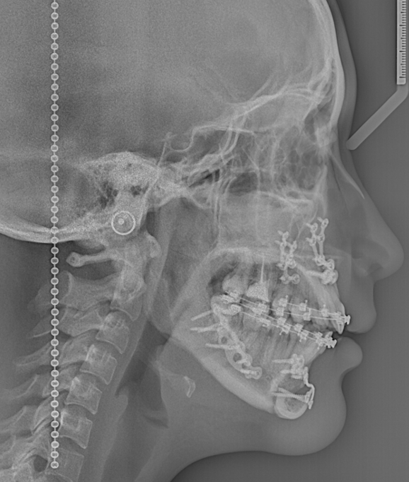 via-aerea-despues-de-cirugia-clinica-oralmaxq