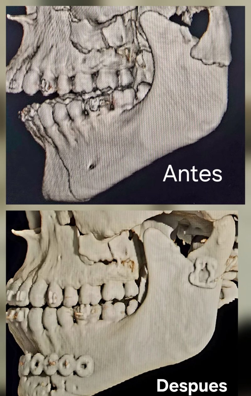 Fractura mandibular antes y despues