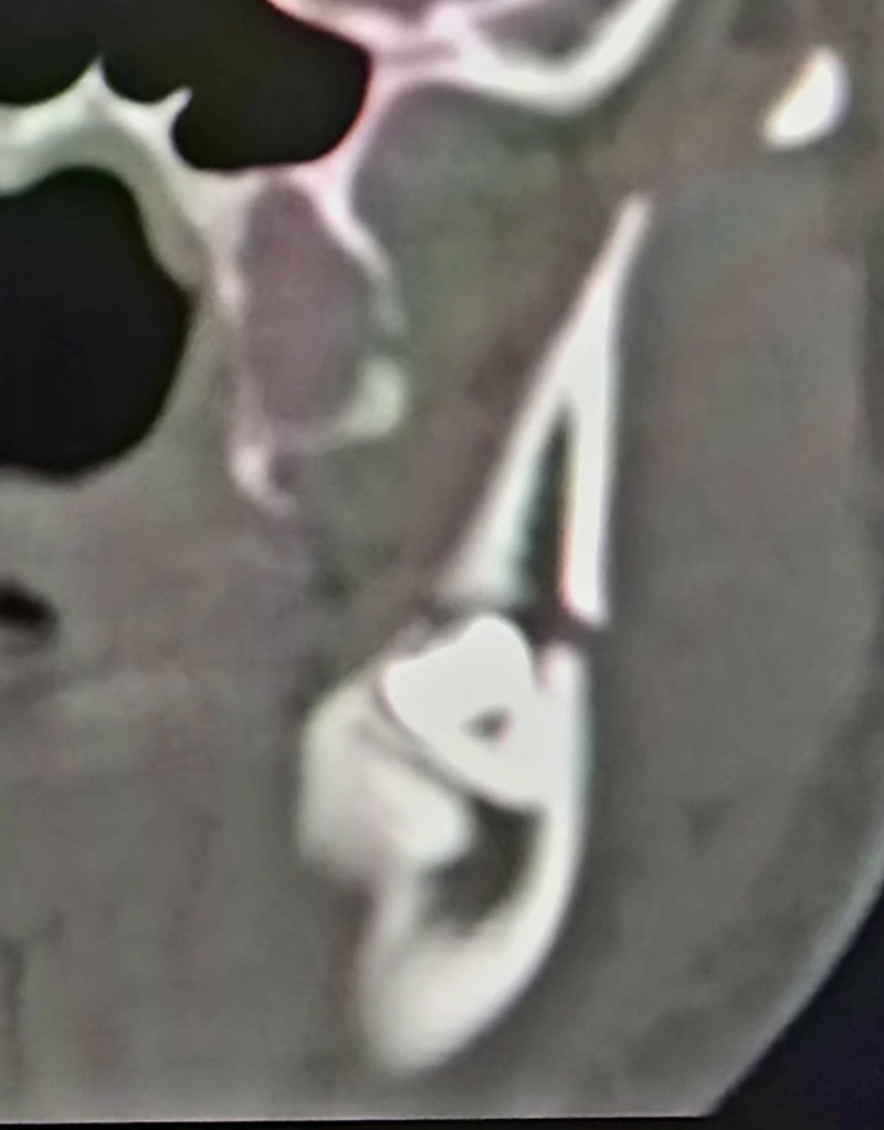 Tomografia de tercer molar inferior