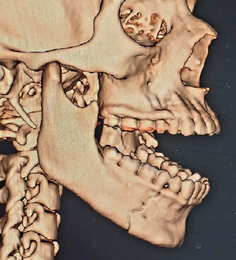Tomografia Lateral de fractura mandibular