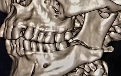 Muelas del juicio y fractura mandibular: ¿qué relación tienen?