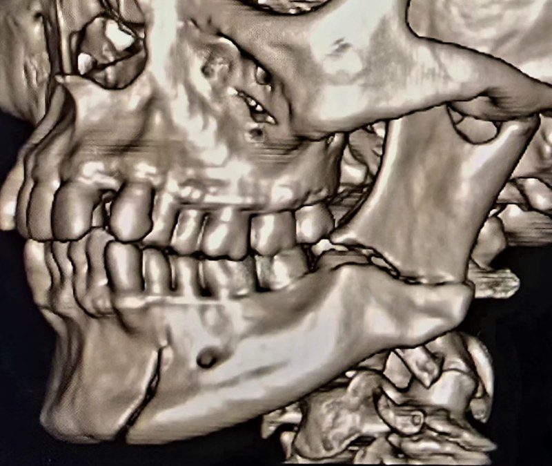 Reconstrucción de Mandibula