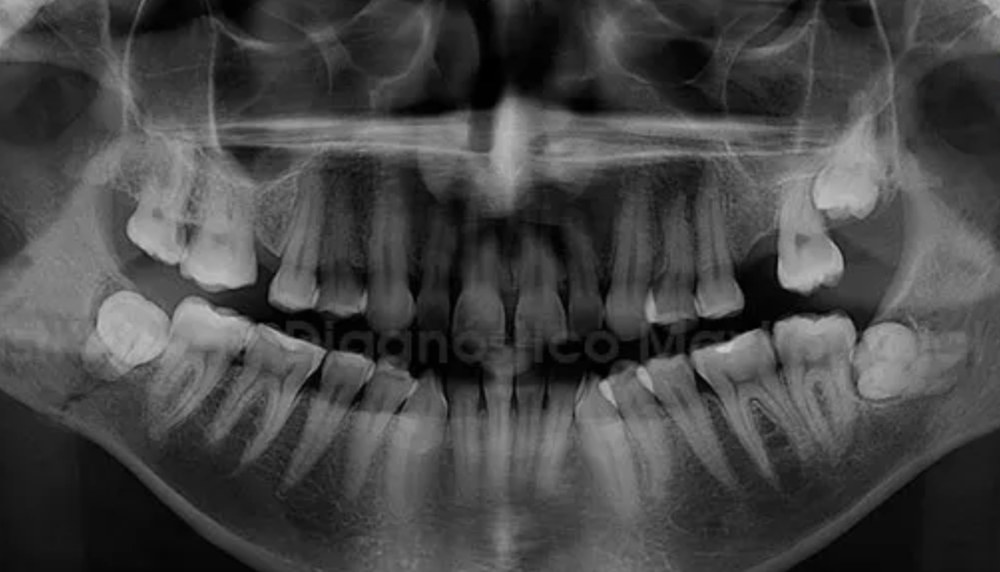 Radiografia panorámica de muelas de juicio