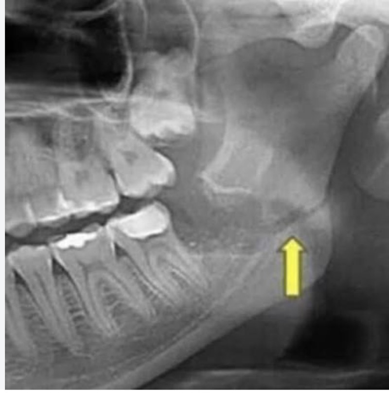 Radiografia señalizada de angulo mandibular
