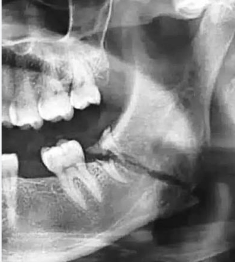 Radiografía Angulo mandibular