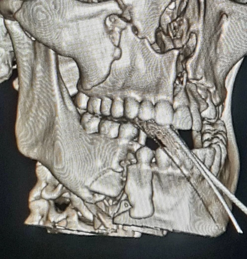 Tomografia de una fractura mandibular