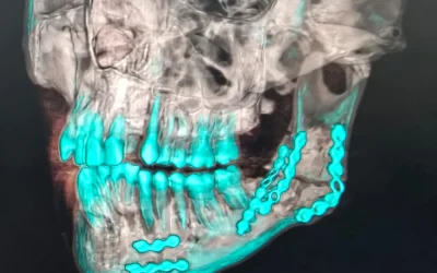 Fracturas de mandíbula: tipos y casos más frecuentes