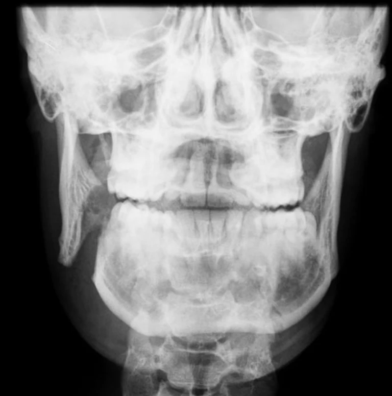 Radiografía de mandibula